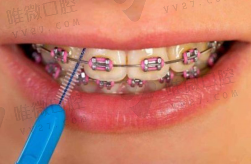 登士柏树脂牙（Sdr树脂）(图1)